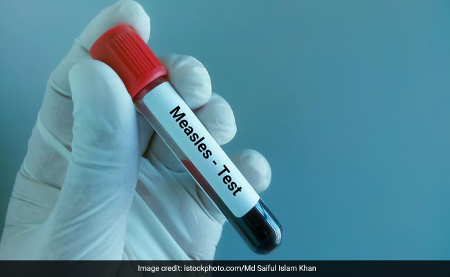 Measles: Know Symptoms And Prevention Tips For This Viral Infection